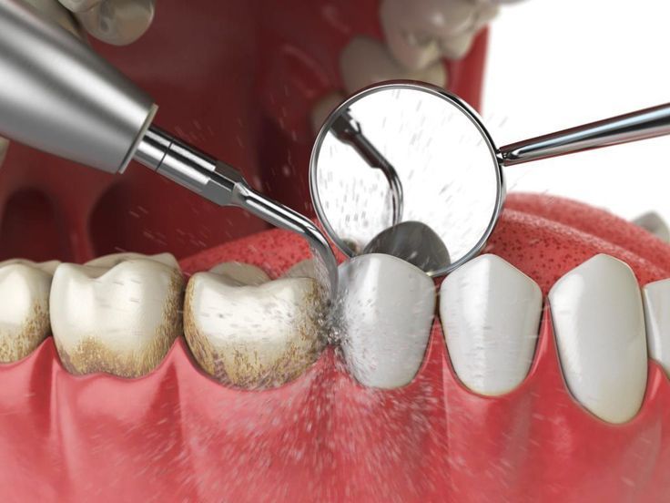 Laser Dentistry Image