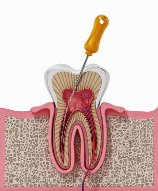 Root Canal treatment process Ongole