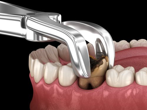 damage caused by infection or Tooth decay Image