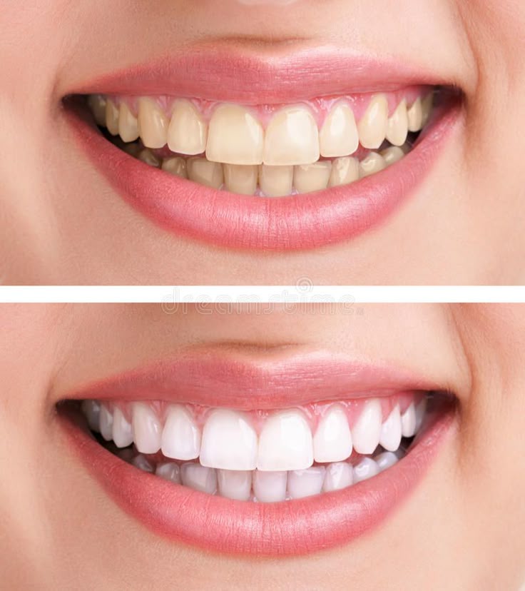 How to Whitening Teeth Gentle teeth whitening for sensitive teeth solution