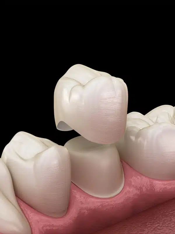 Dental Crown Image