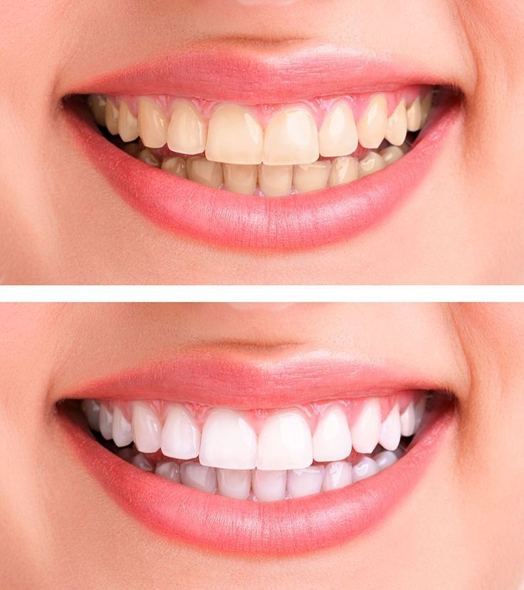 pain free teeth whitening for sensitive teeth option