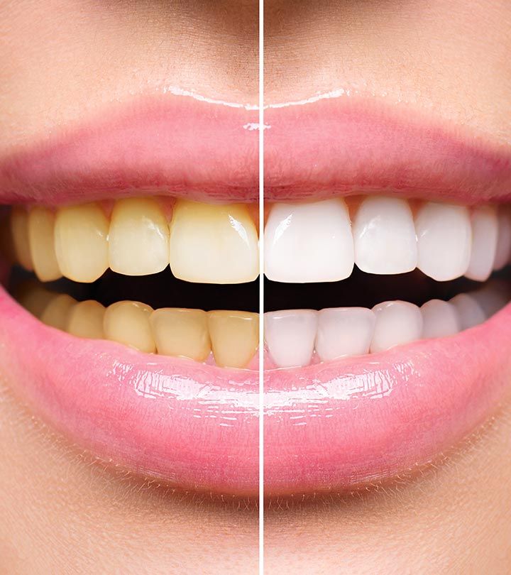Teeth Whitening treatment Ongole