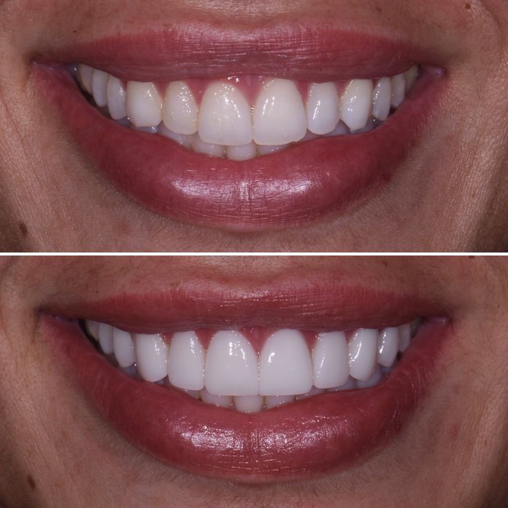painless composite bonding for broken teeth