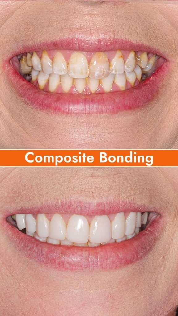cosmetic Composite bonding for  broken teeth damaged teeth